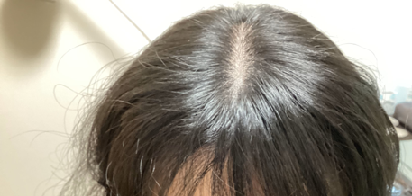 糖化が髪を老けさせる？血糖値・AGEsと薄毛を鍼灸で防ぐ