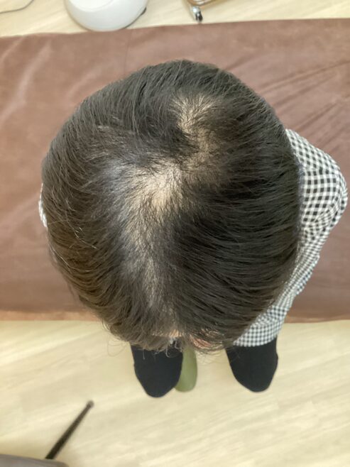毛包の萎縮（ミニチュア化）を防ぐ方法｜鍼灸で細い毛を健康な毛に戻すケア