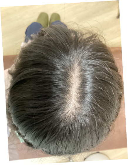 冷え性と薄毛の深い関係｜体の冷えが頭皮血流を阻害する仕組みと鍼灸ケア