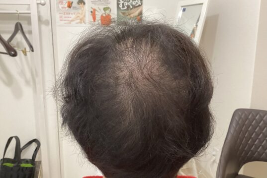 美容鍼は顔だけじゃない！美容発毛ラボ芦屋で、全身の巡りを整え、頭皮と髪の健康、そして発毛を同時に目指す