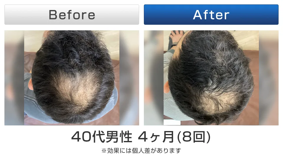 神戸で心身ともにリフレッシュ！ストレス性薄毛に効く鍼灸で自律神経のバランスを整える