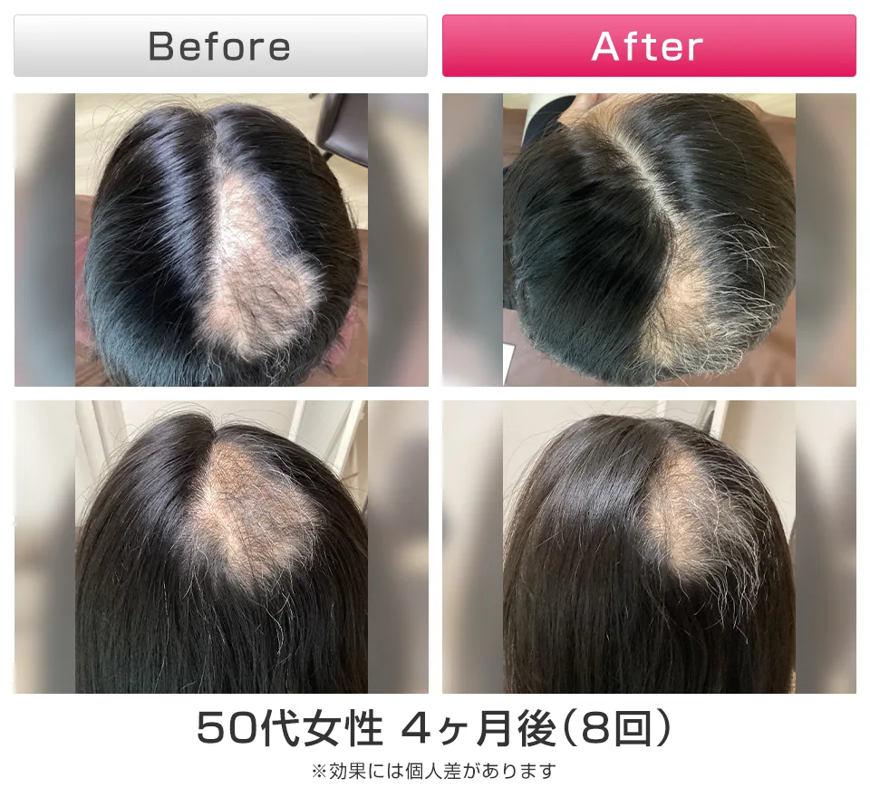 神戸で叶える、憧れのボリュームと輝き｜美容鍼灸で髪の潜在能力を引き出す
