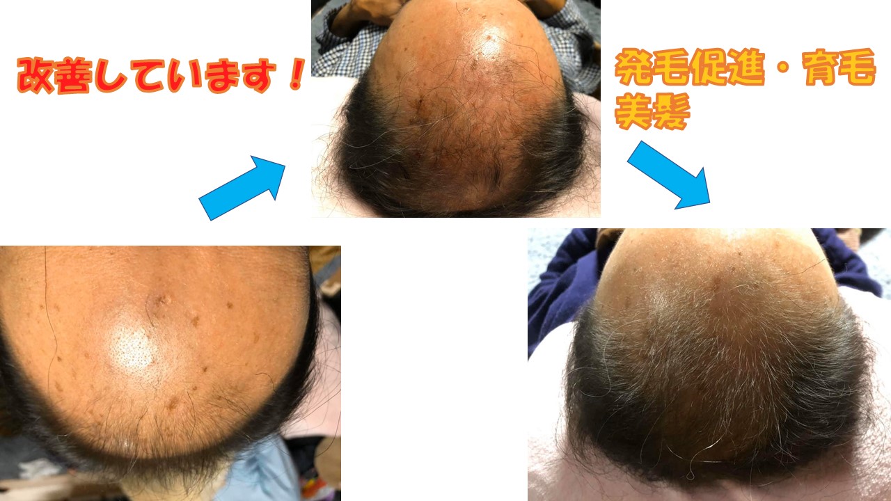 更年期の髪の悩み、諦めないで｜芦屋の鍼灸でハリとコシを取り戻す