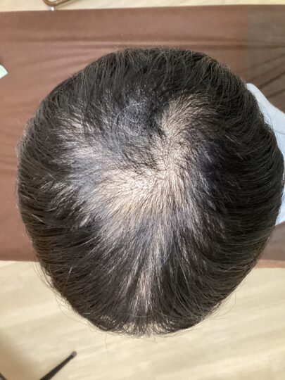 ストレスで薄毛・抜け毛が進行？芦屋の鍼灸で自律神経を整え、健やかな髪へ