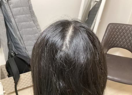 頭皮が固いと薄毛になる?|前頭筋・側頭筋のコリを整体と鍼灸でゆるめる