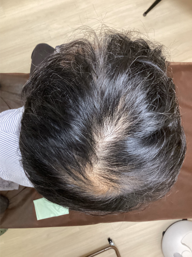 頭頂部の薄毛に悩む男性へ｜育毛鍼でできること